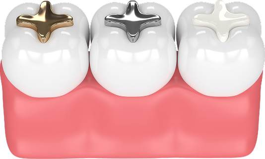 インレーの3Dイラスト