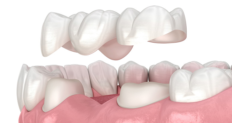 ブリッジの3D画像